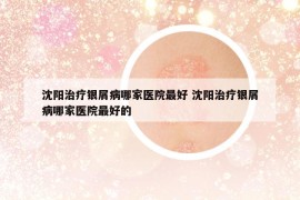 沈陽治療銀屑病哪家醫(yī)院最好 沈陽治療銀屑病哪家醫(yī)院最好的