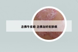 念佛牛皮癬 念佛治好皮膚病