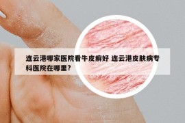 連云港哪家醫(yī)院看牛皮癬好 連云港皮膚病?？漆t(yī)院在哪里?
