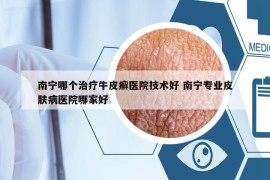 南寧哪個治療牛皮癬醫(yī)院技術(shù)好 南寧專業(yè)皮膚病醫(yī)院哪家好