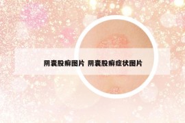 陰囊股癬圖片 陰囊股癬癥狀圖片