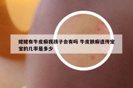 姥姥有牛皮癬我孩子會(huì)有嗎 牛皮膚癬遺傳寶寶的幾率是多少
