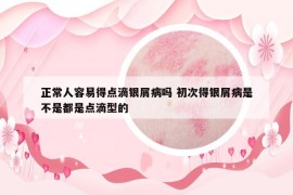 正常人容易得點(diǎn)滴銀屑病嗎 初次得銀屑病是不是都是點(diǎn)滴型的