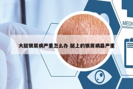 大腿銀屑病嚴(yán)重怎么辦 腿上的銀屑病最嚴(yán)重