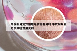 牛皮癬用復(fù)方酮康唑軟膏有用嗎 牛皮癬用復(fù)方酮康唑發(fā)用洗劑