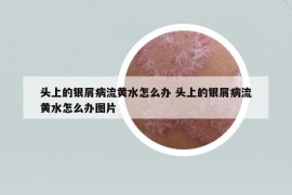 頭上的銀屑病流黃水怎么辦 頭上的銀屑病流黃水怎么辦圖片