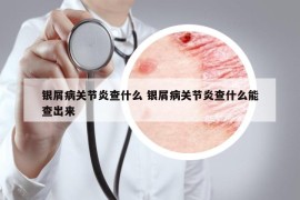 銀屑病關(guān)節(jié)炎查什么 銀屑病關(guān)節(jié)炎查什么能查出來(lái)