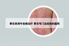 黃石民間牛皮癬治療 黃石專門治皮膚的醫(yī)院