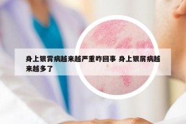 身上銀霄病越來越嚴(yán)重咋回事 身上銀屑病越來越多了