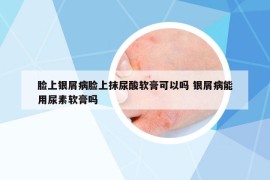 臉上銀屑病臉上抹尿酸軟膏可以嗎 銀屑病能用尿素軟膏嗎