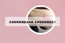 點(diǎn)滴型銀屑病能當(dāng)兵嘛 點(diǎn)滴型銀屑病自愈了