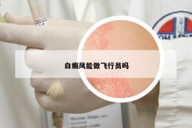 白癜風能做飛行員嗎