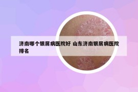 濟(jì)南哪個(gè)銀屑病醫(yī)院好 山東濟(jì)南銀屑病醫(yī)院排名