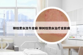 柳枝煮水洗牛皮癬 柳樹(shù)枝熬水治療皮膚病