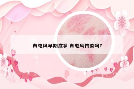 白電風(fēng)早期癥狀 白電風(fēng)傳染嗎?