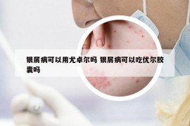 銀屑病可以用尤卓爾嗎 銀屑病可以吃優(yōu)爾膠囊嗎