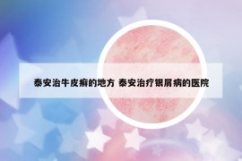 泰安治牛皮癬的地方 泰安治療銀屑病的醫(yī)院