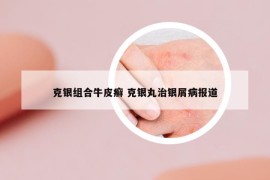 克銀組合牛皮癬 克銀丸治銀屑病報(bào)道