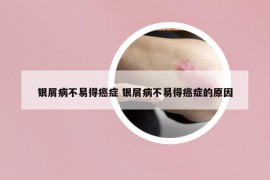 銀屑病不易得癌癥 銀屑病不易得癌癥的原因