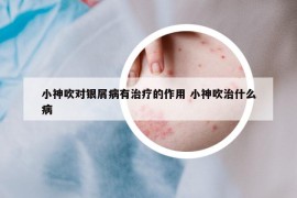 小神吹對銀屑病有治療的作用 小神吹治什么病