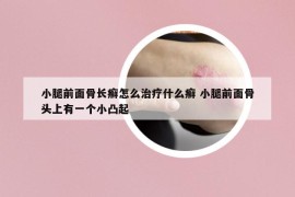 小腿前面骨長癬怎么治療什么癬 小腿前面骨頭上有一個小凸起