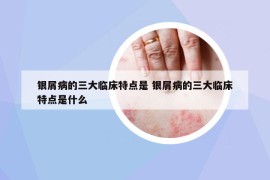 銀屑病的三大臨床特點(diǎn)是 銀屑病的三大臨床特點(diǎn)是什么