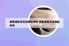 銀屑病影響艾滋病檢測嗎 銀屑病是艾滋病前兆嗎