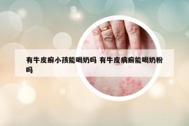 有牛皮癬小孩能喝奶嗎 有牛皮病癬能喝奶粉嗎