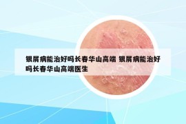 銀屑病能治好嗎長春華山高端 銀屑病能治好嗎長春華山高端醫(yī)生
