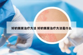 好的銀屑治療方法 好的銀屑治療方法是什么