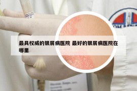 最具權(quán)威的銀屑病醫(yī)院 最好的銀屑病醫(yī)院在哪里