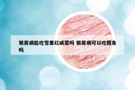 銀屑病能吃雪里紅咸菜嗎 銀屑病可以吃鱈魚嗎