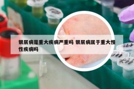 銀屑病是重大疾病嚴重嗎 銀屑病屬于重大慢性疾病嗎