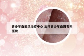 青少年白癜風(fēng)治療中心 治療青少年白斑專科醫(yī)院