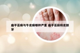 扁平苔癬與牛皮癬哪種嚴(yán)重 扁平苔蘚和皮膚牙