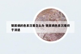 銀屑病的色素沉著怎么辦 銀屑病色素沉著終于消退