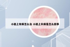 小腿上有癬怎么治 小腿上長癬是怎么回事