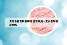 發(fā)燒會復(fù)發(fā)銀屑病嗎 感冒發(fā)燒一定會引發(fā)銀屑病嗎