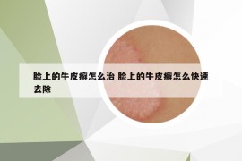臉上的牛皮癬怎么治 臉上的牛皮癬怎么快速去除