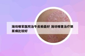 濰坊哪家醫(yī)院治牛皮癬最好 濰坊哪里治療銀屑病比較好