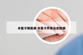 木鱉子銀屑病 木鱉子外用治皮膚病