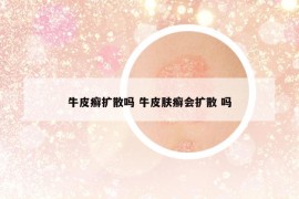 牛皮癬擴(kuò)散嗎 牛皮膚癬會(huì)擴(kuò)散 嗎