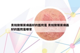 貴陽做銀屑病最好的醫(yī)院是 貴陽做銀屑病最好的醫(yī)院是哪家