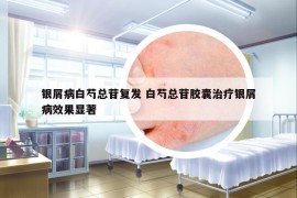 銀屑病白芍總苷復發(fā) 白芍總苷膠囊治療銀屑病效果顯著