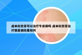 鹵米松軟膏可以治療牛皮癬嗎 鹵米松軟膏治療銀屑病效果如何