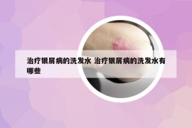 治療銀屑病的洗發(fā)水 治療銀屑病的洗發(fā)水有哪些