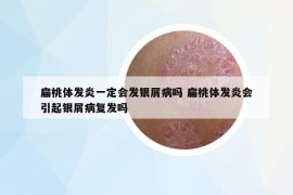 扁桃體發(fā)炎一定會(huì)發(fā)銀屑病嗎 扁桃體發(fā)炎會(huì)引起銀屑病復(fù)發(fā)嗎
