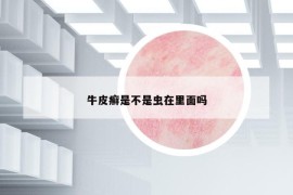 牛皮癬是不是蟲(chóng)在里面嗎