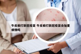 牛皮癬打新冠疫苗 牛皮癬打新冠疫苗會(huì)加重病情嗎
