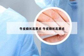 牛皮癬長(zhǎng)出黑點(diǎn) 牛皮癬長(zhǎng)出黑點(diǎn)